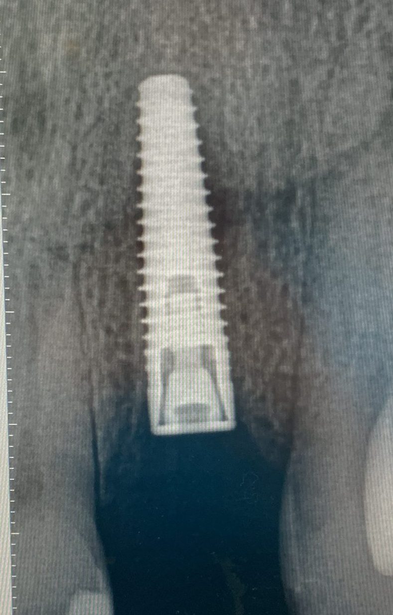 Dental implants