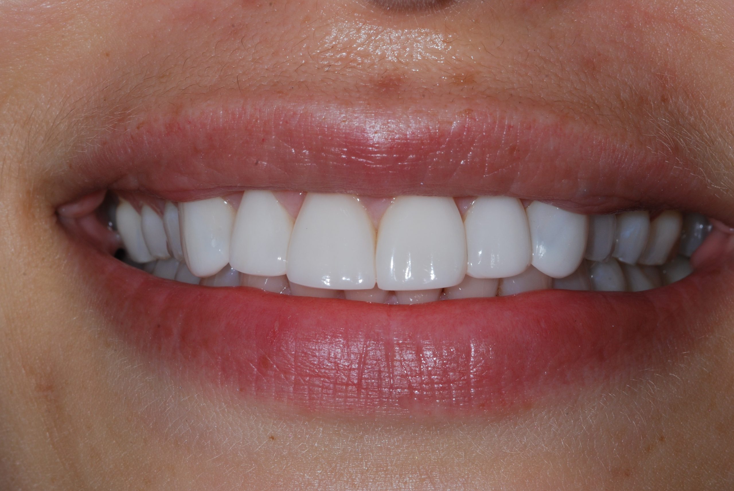 Composite bonding and Veneers
